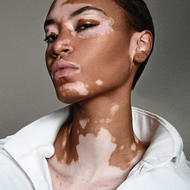 Vitiligo